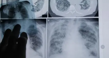 肺结节不治疗，会有哪些并发症？